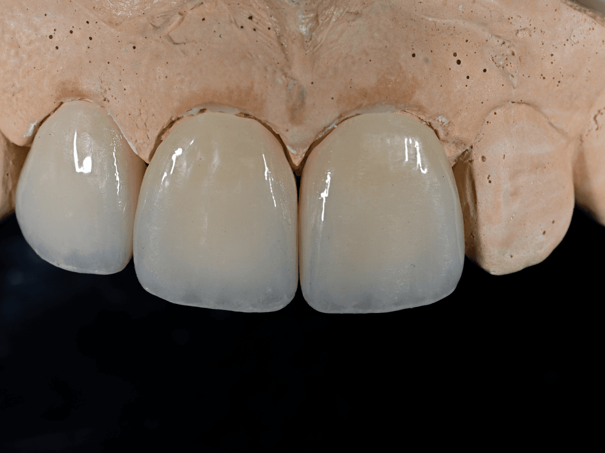 Anterior Full Zirconia — product shot