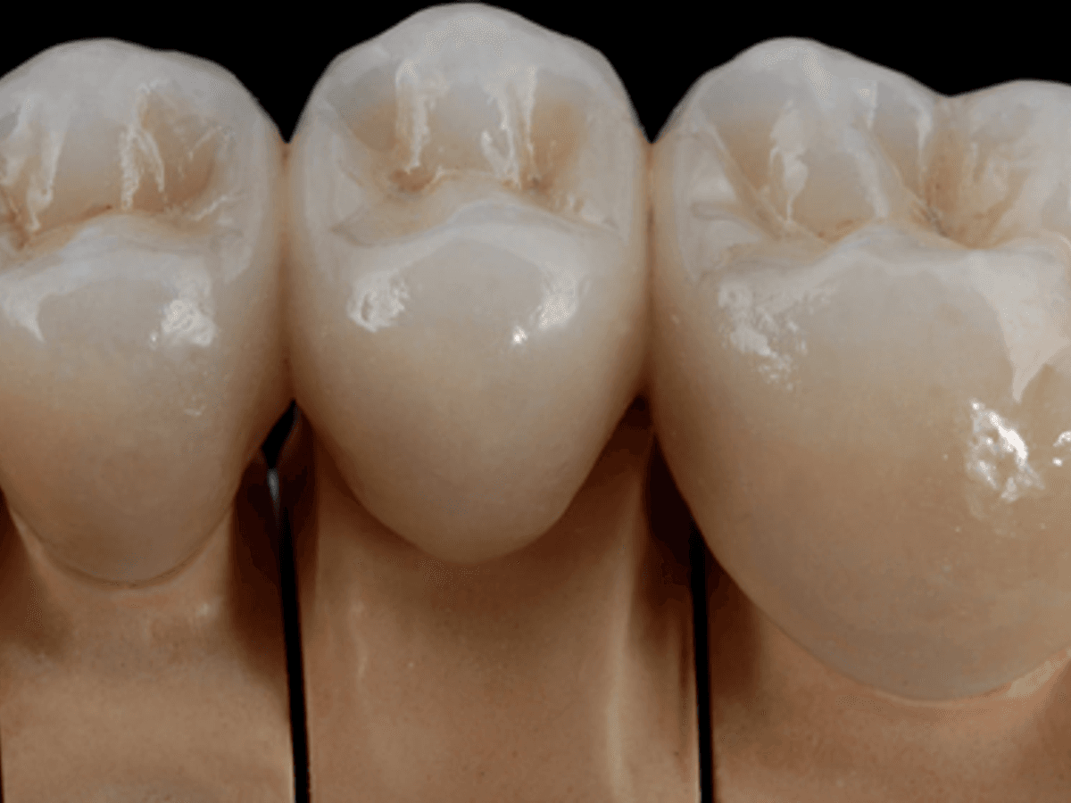 Posterior Full Zirconia — image 1