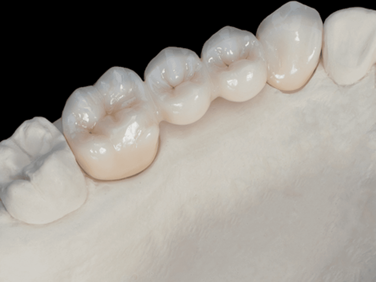 Posterior Full Zirconia — product shot
