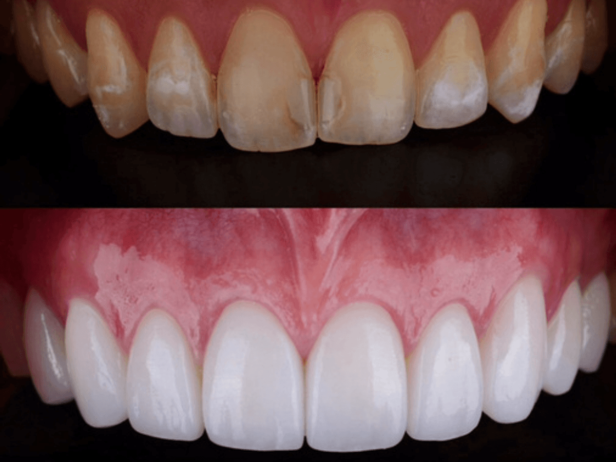 Posterior Full Zirconia — image 3