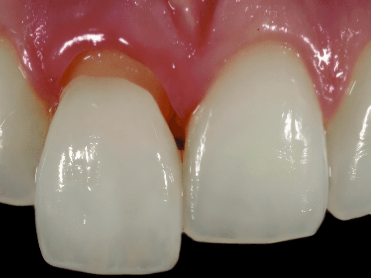 Anterior Full Zirconia — image 1