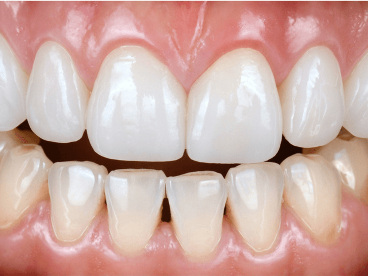 Anterior Full Zirconia — image 2
