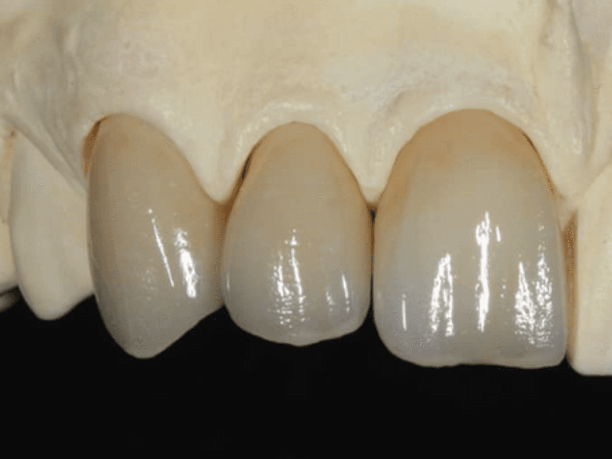 Anterior Full Zirconia — image 3