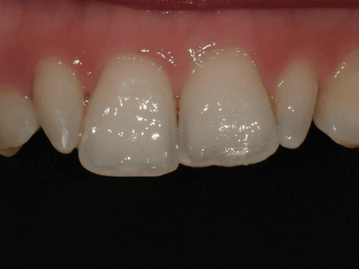 Laminate Veneer — image 4