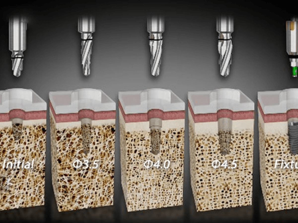 Implant Surgical Guide — image 1