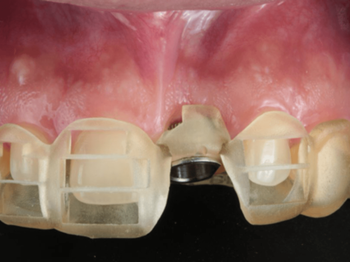 Implant Surgical Guide — image 2