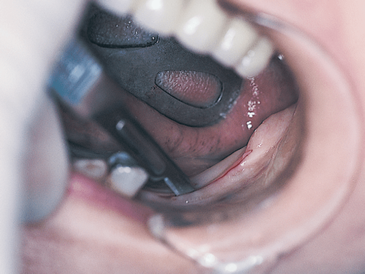 Implant Surgical Guide — image 3