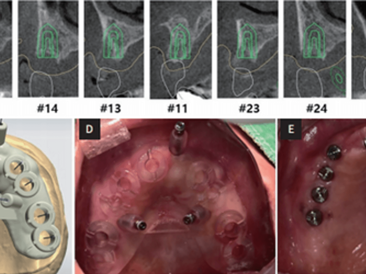 Implant Surgical Guide — image 4