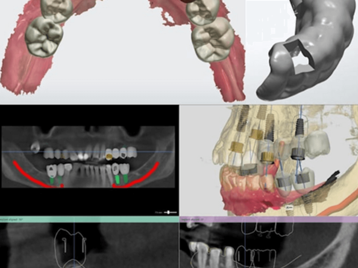 Implant Healing Scan Body — image 1